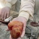 Врачи извлекли из мочевого пузыря курянина камень размером с апельсин